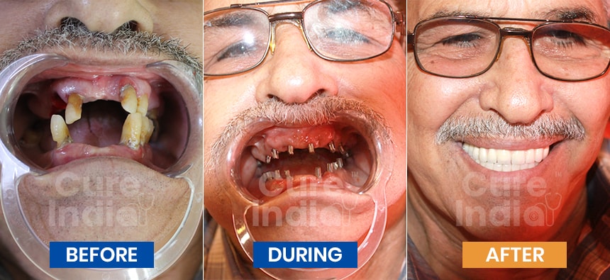 Full Mouth Dental Implant before after